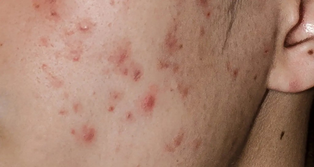 Serum Untuk Atasi Jerawat yang Aman Dipakai&nbsp;Harian!