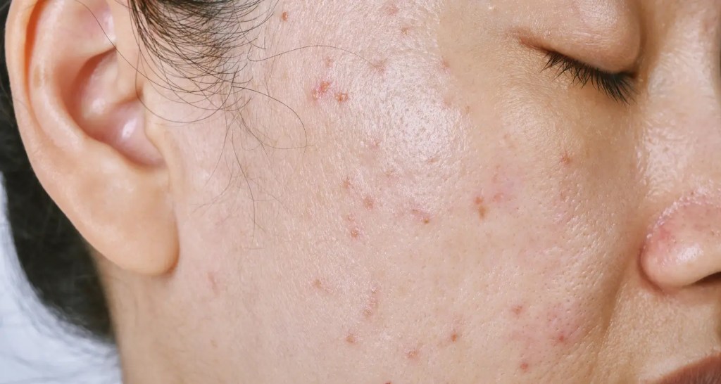 Bekas Jerawat Susah Hilang? Ini&nbsp;Solusinya!